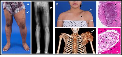 Hyperphosphatemic Tumoral Calcinosis: Pathogenesis, Clinical Presentation, and Challenges in Management